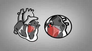 متى يكون ارتخاء الصمام الميترالي خطير؟- حسام موافي يكشف